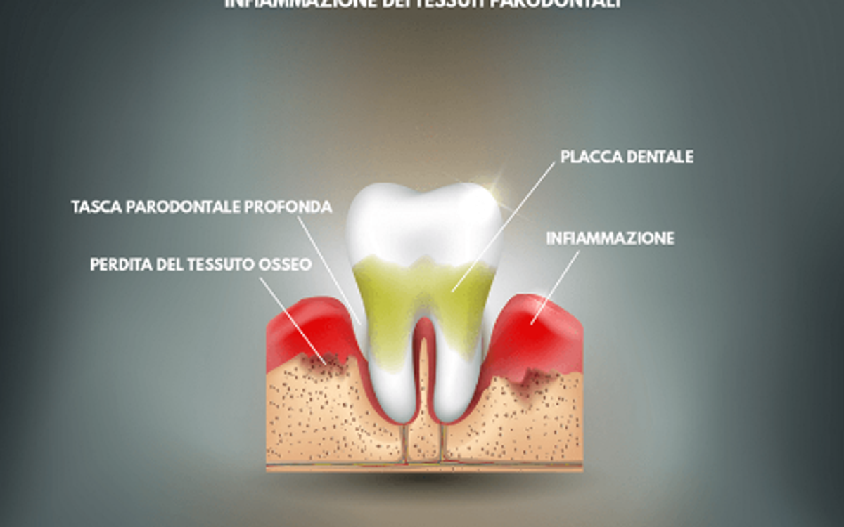 Parodontite: cos’è, perché si forma e cosa significa avere una tasca gengivale