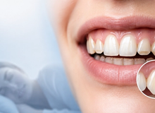 Digrigni i denti la notte? Perché il bite non cura il bruxismo (ma può salvarti i denti)