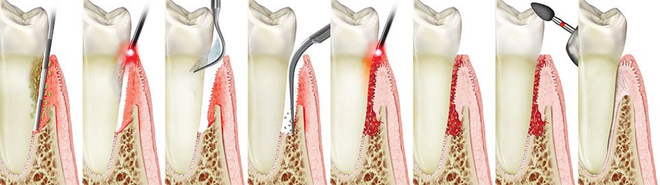 Laser Periodontal Therapy in Oakland, CA