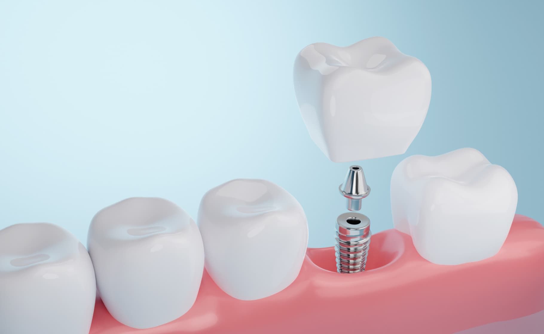 3D rending of a dental implant which provides high quality replacement for missing teeth