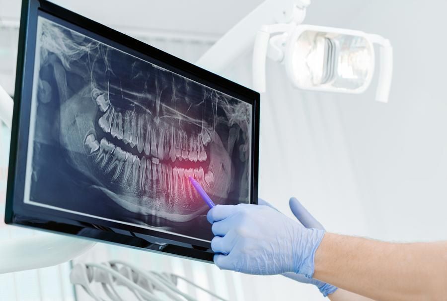 dentist in gloves show the teeth on x-ray on digital screen in Oakland CA periodontist dental clinic