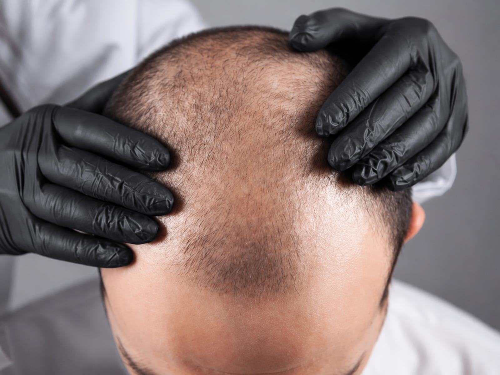 Gloved hands parting thinning hair to assess the scalp during a consultation