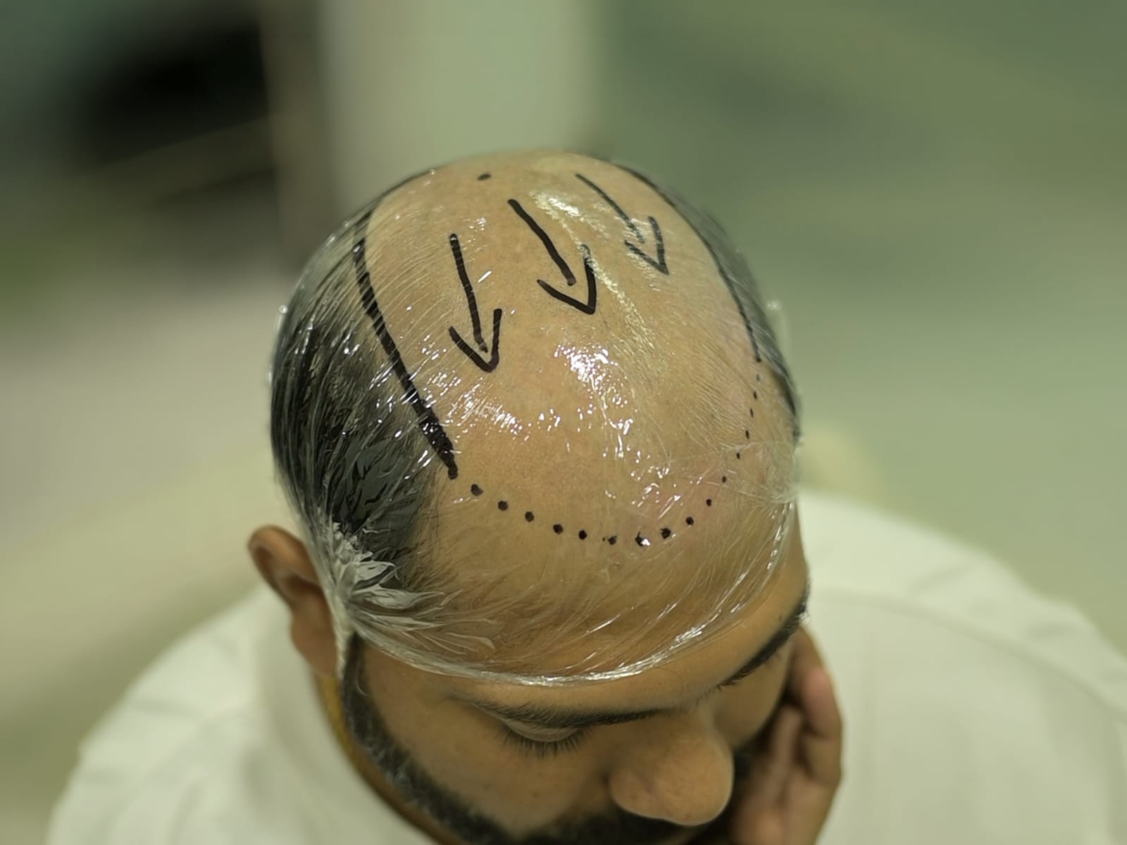 A scalp wrapped in film with the hairline and hair direction marked out for a custom template