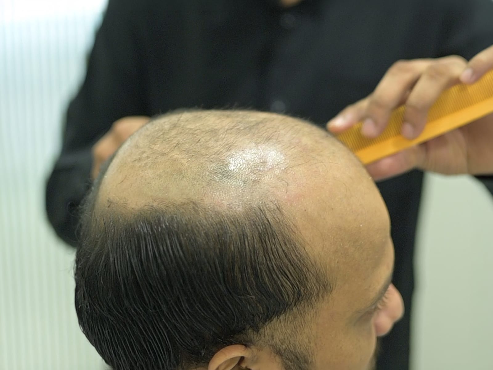 The scalp combed and prepared in the studio before a hair system is refitted