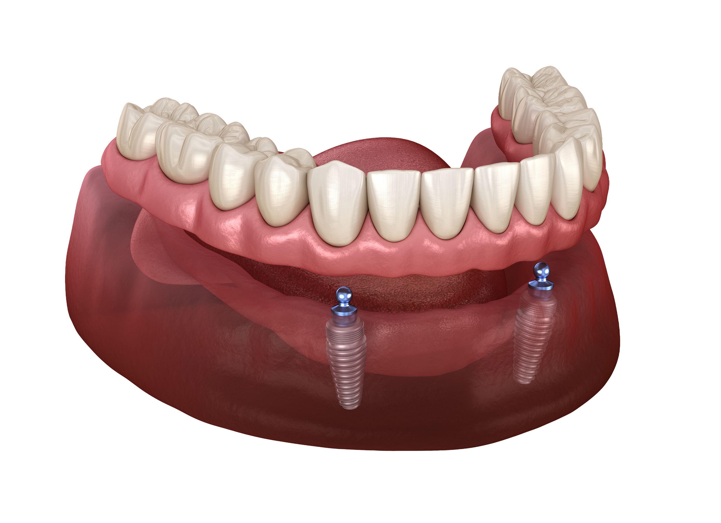 implant secured denture jaw diagram