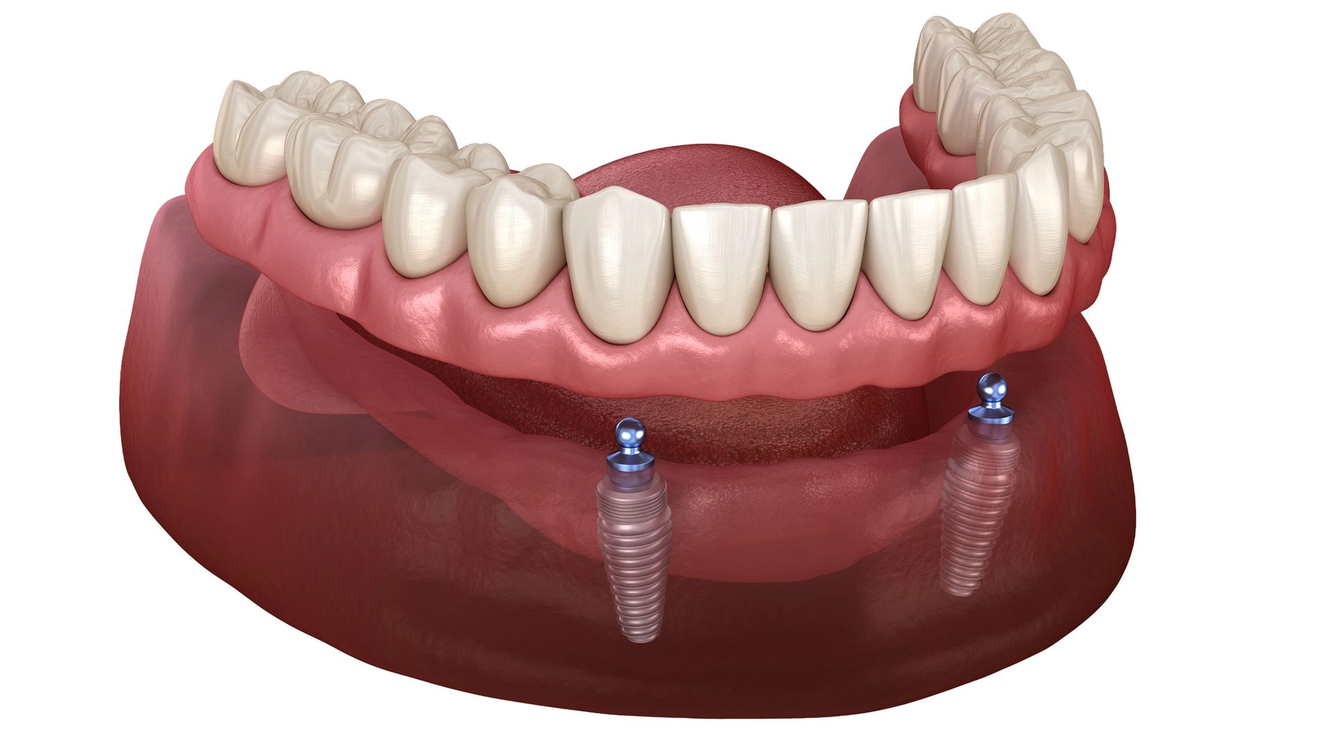 implant secured denture jaw diagram