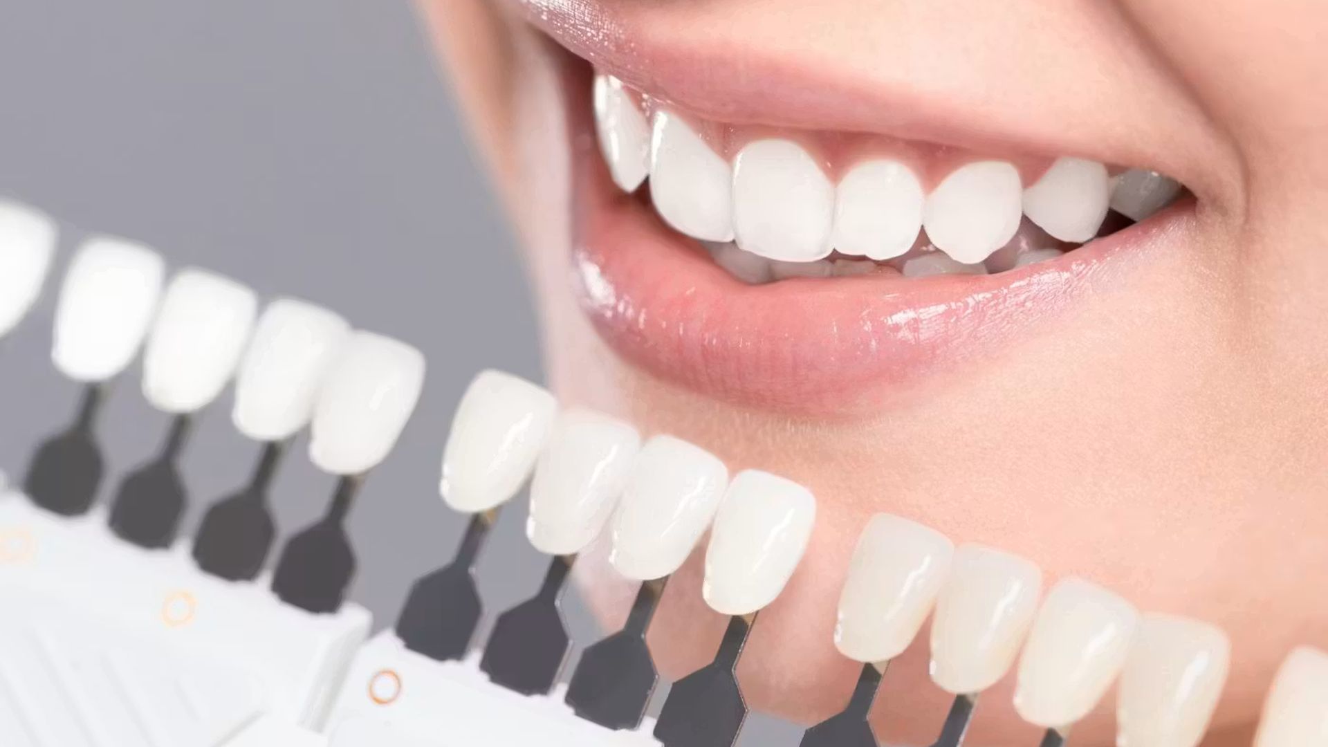 Teeth Whitening 2
