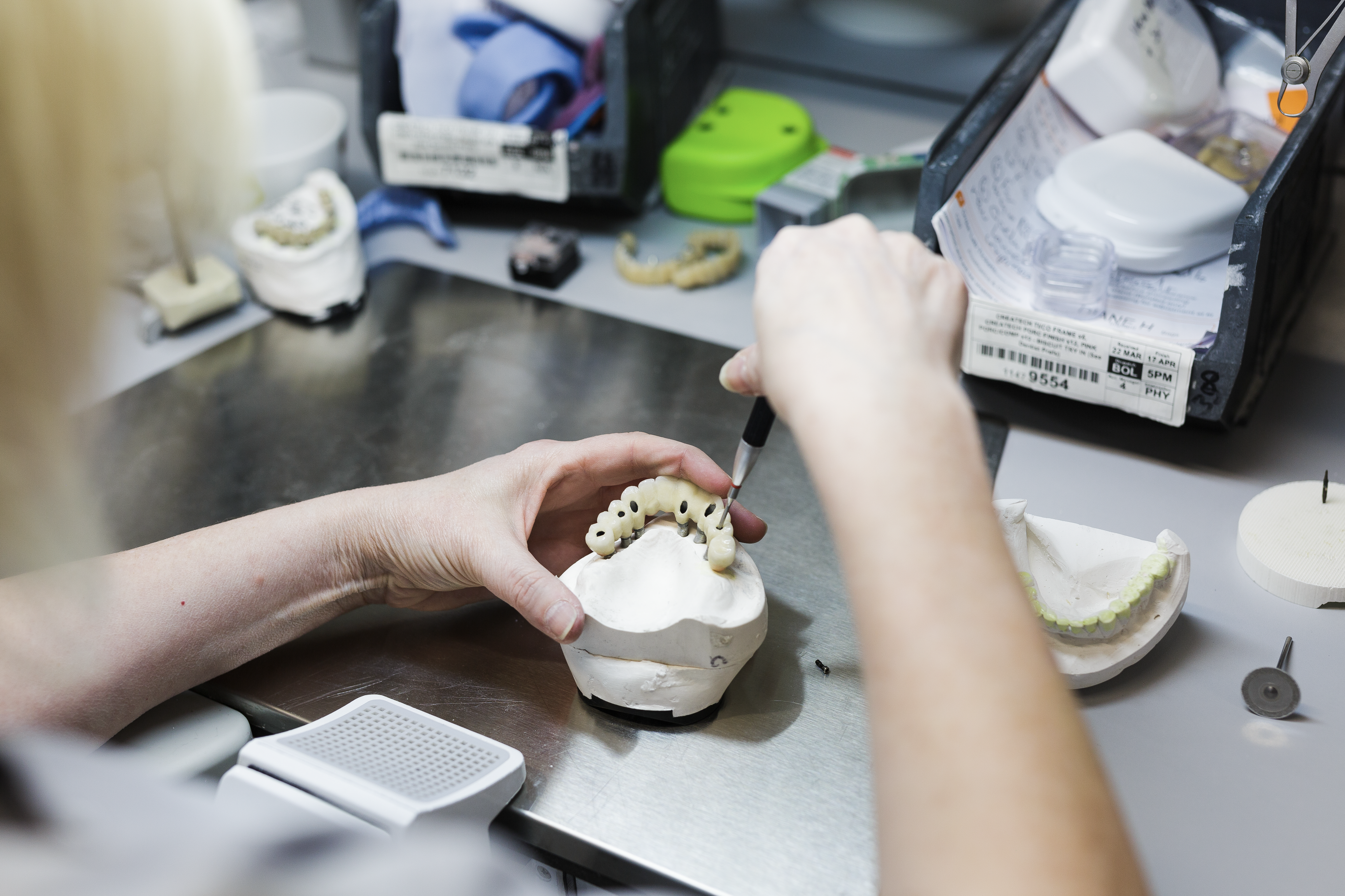 A dental technician holds a plaster model with an implant-supported prosthesis featuring multiple tooth-colored crowns during laboratory fabrication, surrounded by dental equipment and materials.