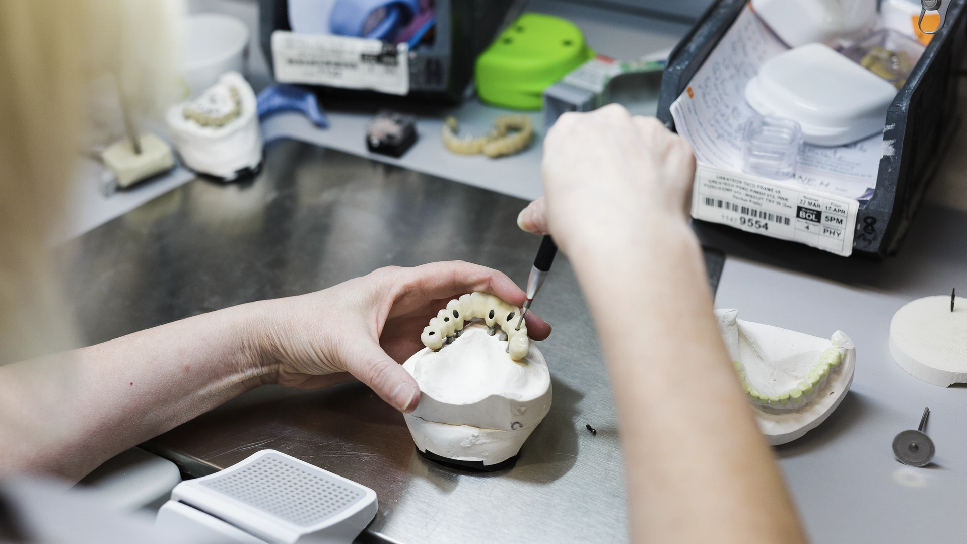 A dental technician holds a plaster model with an implant-supported prosthesis featuring multiple tooth-colored crowns during laboratory fabrication, surrounded by dental equipment and materials.