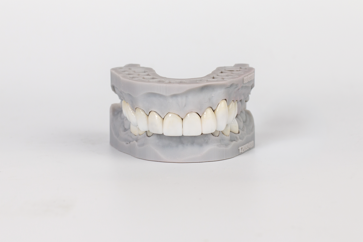 A dental laboratory model displaying a multi-unit porcelain crown bridge with seven tooth-colored ceramic restorations mounted on a gray gypsum cast.