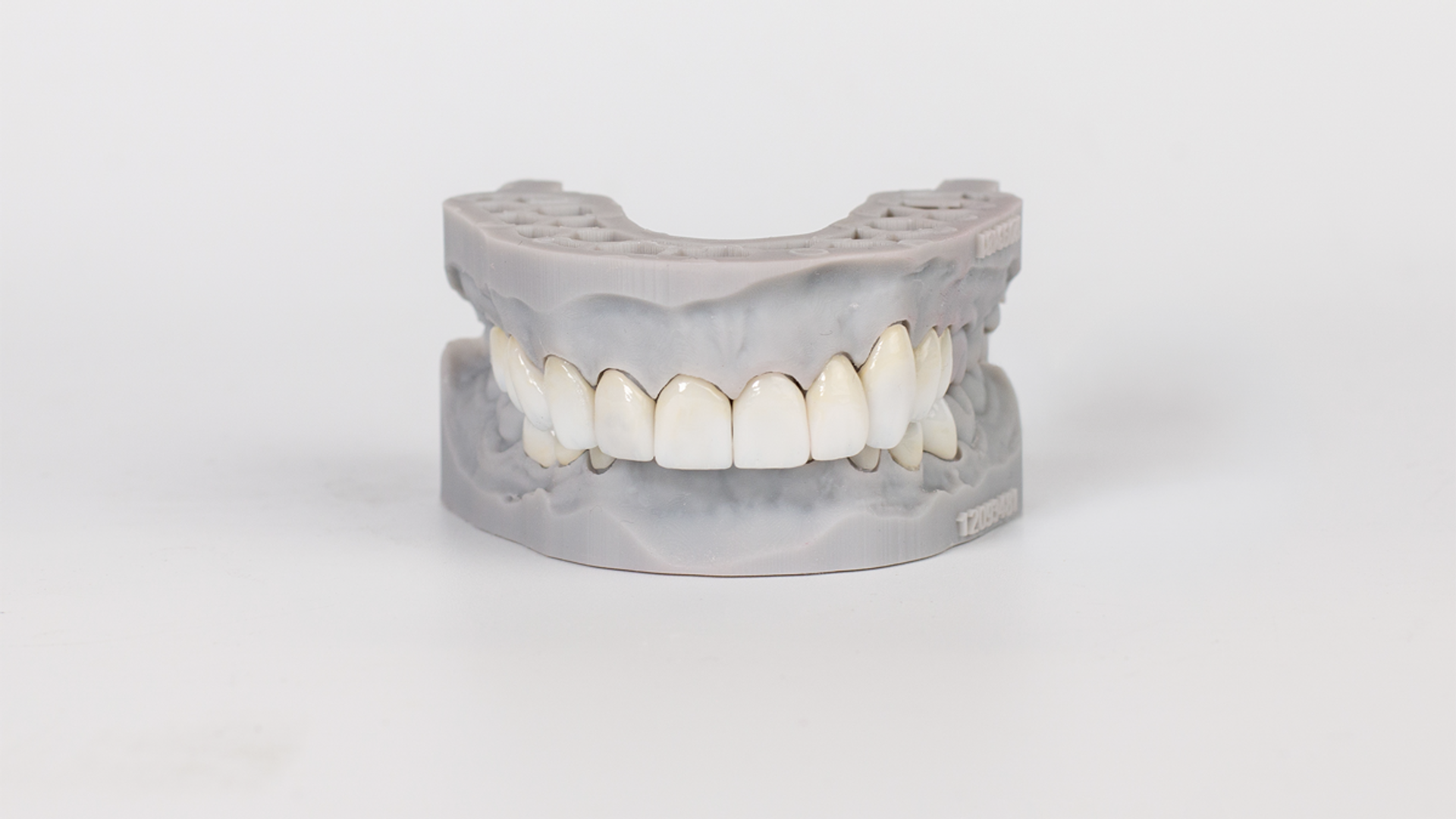 A dental laboratory model displaying a multi-unit porcelain crown bridge with seven tooth-colored ceramic restorations mounted on a gray gypsum cast.
