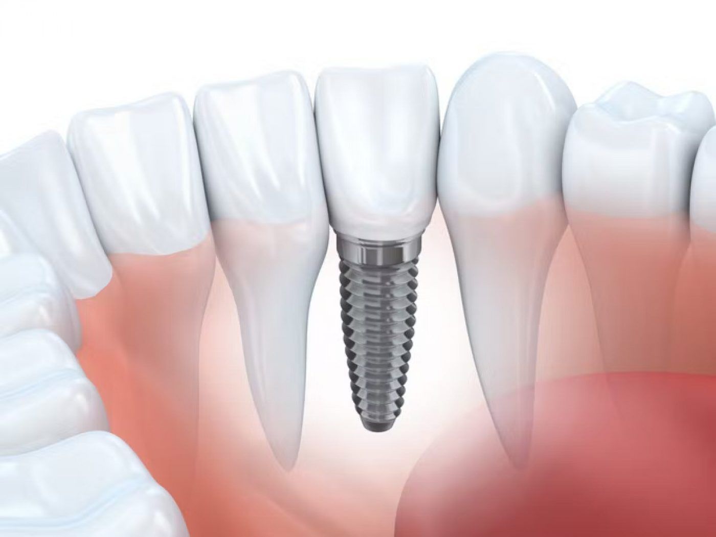 Single dental implants in Cork