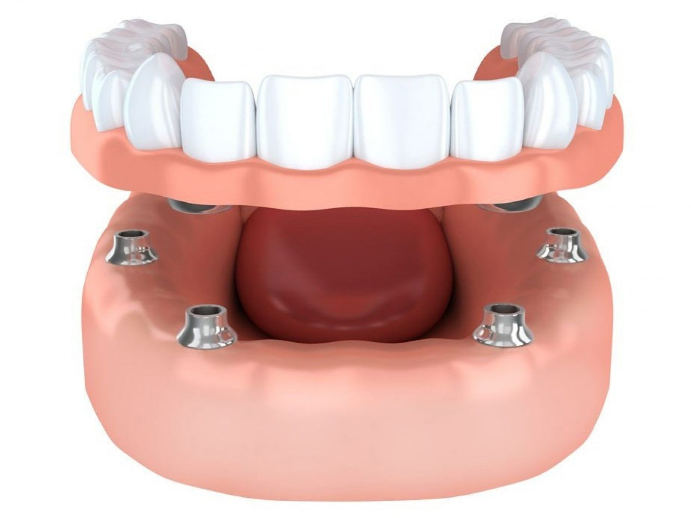 Implant secured dentures in Cork