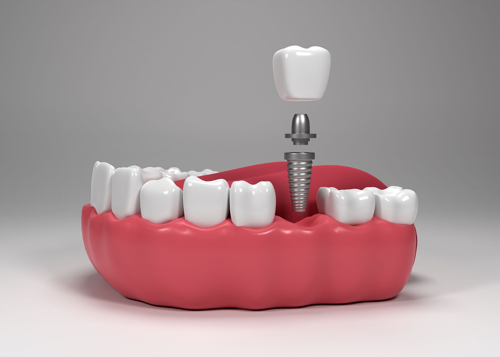 image of dental implant in someone's jaw
