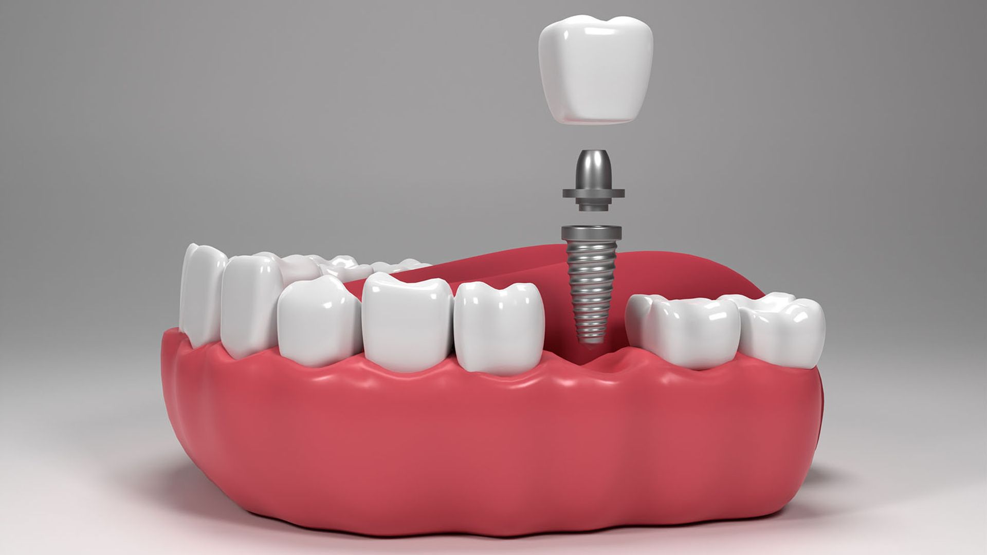 image of dental implant in someone's jaw