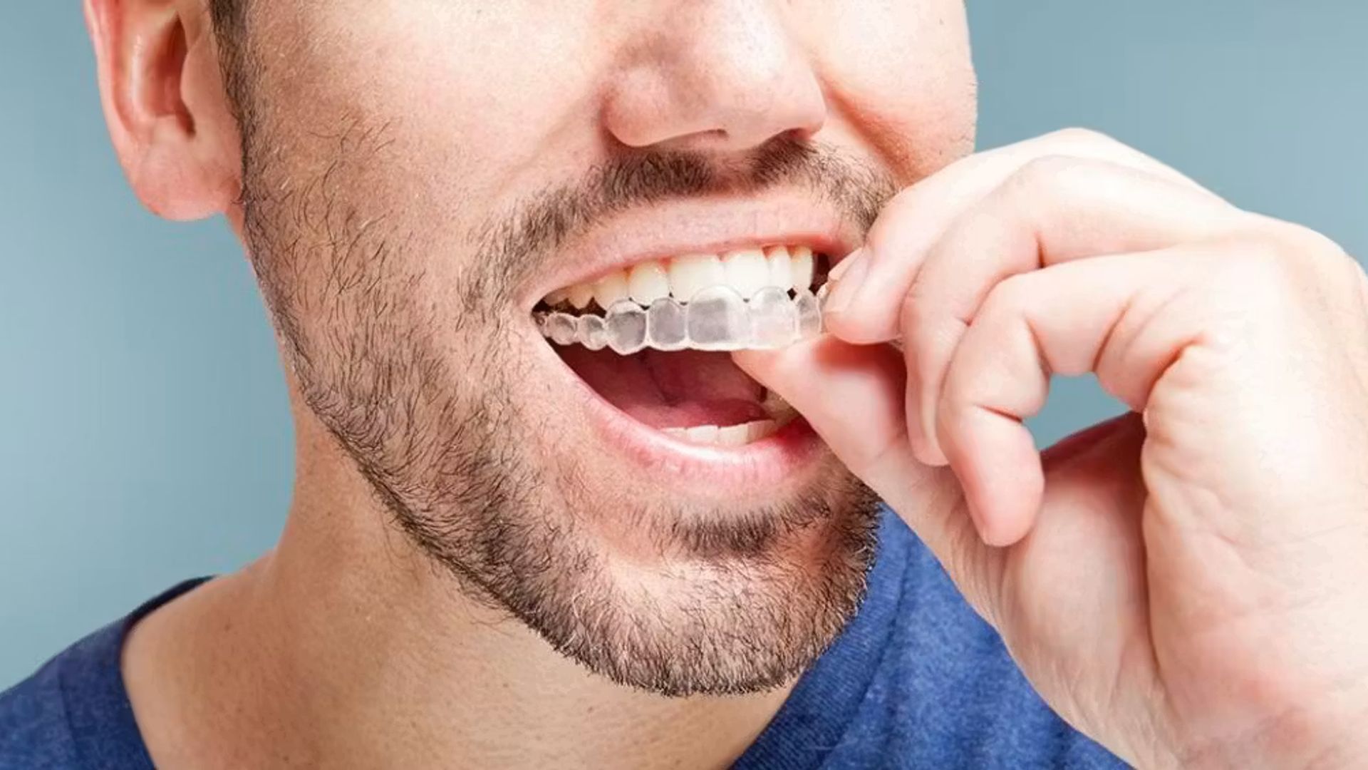 Hdic Orthodontics Invisalign