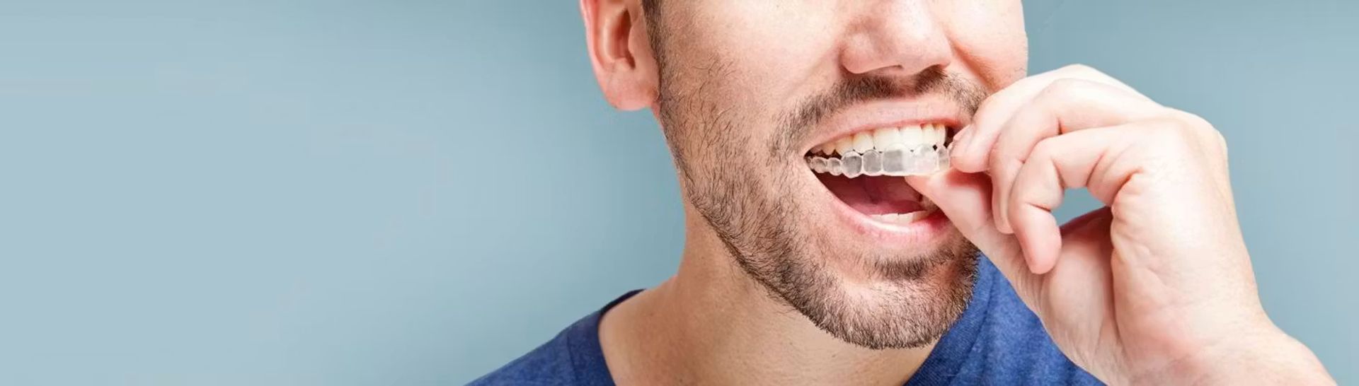 Clear aligners