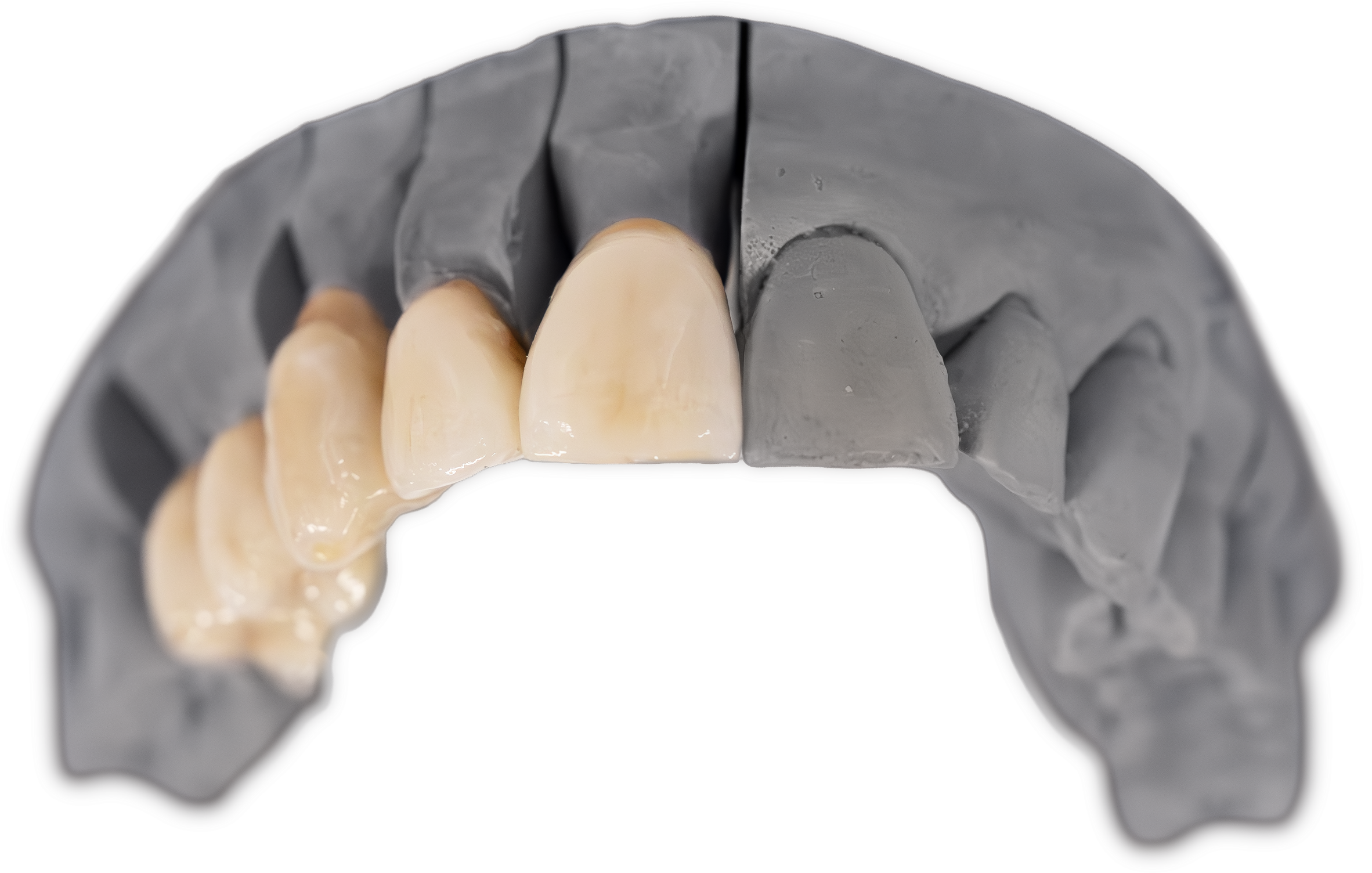 A dental model displaying two tooth-colored ceramic crowns positioned on natural tooth preparations, demonstrating anterior crown restoration planning and design.