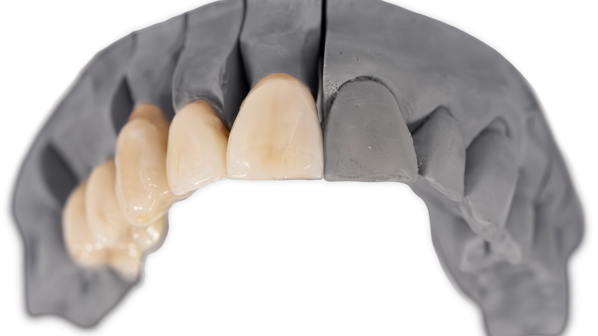 A dental model displaying two tooth-colored ceramic crowns positioned on natural tooth preparations, demonstrating anterior crown restoration planning and design.