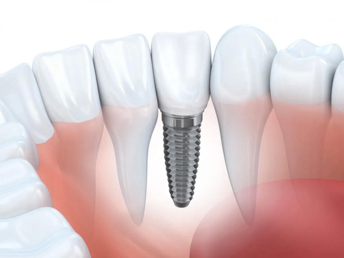 Single Dental Implant in Drighlington