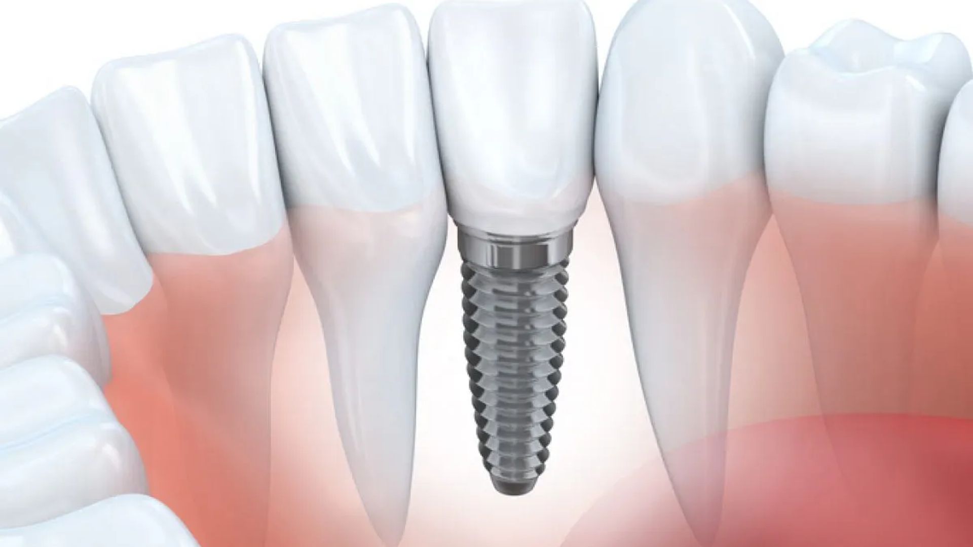 Single Dental Implant in Drighlington