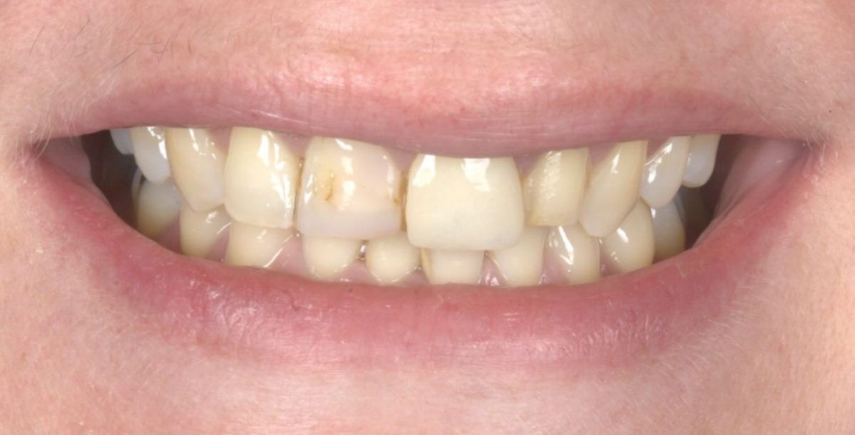 Smile before six porcelain veneers