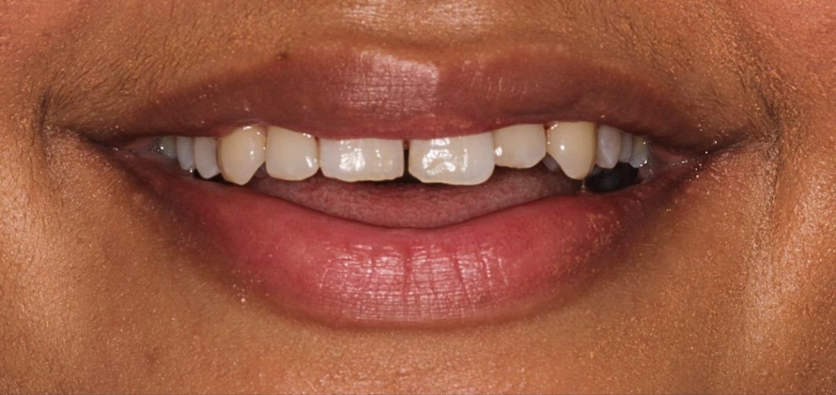 Smile before aligners, whitening and bonding