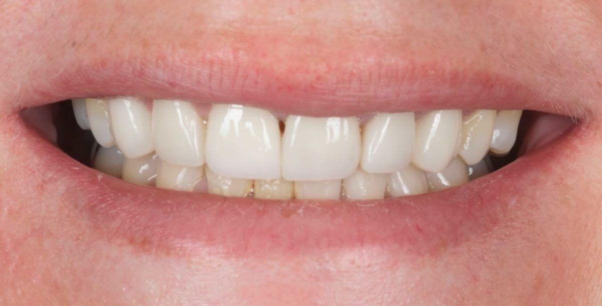 Smile after six porcelain veneers