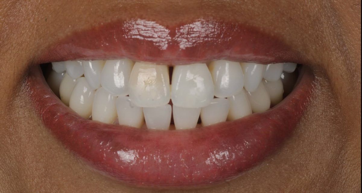 Smile before porcelain veneers for a dark tooth