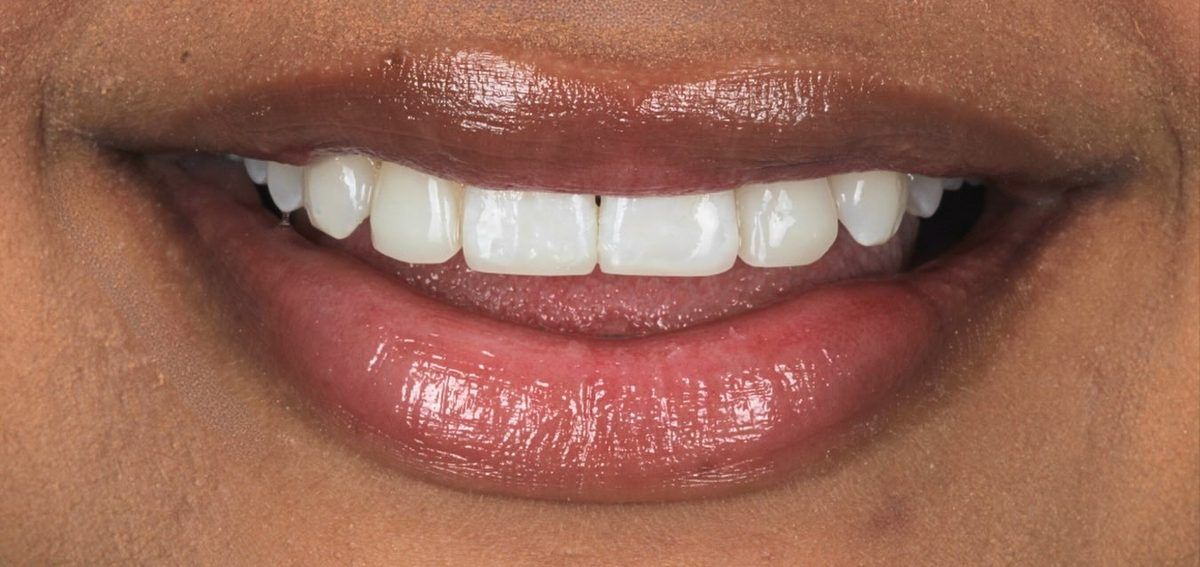 Smile after aligners, whitening and bonding