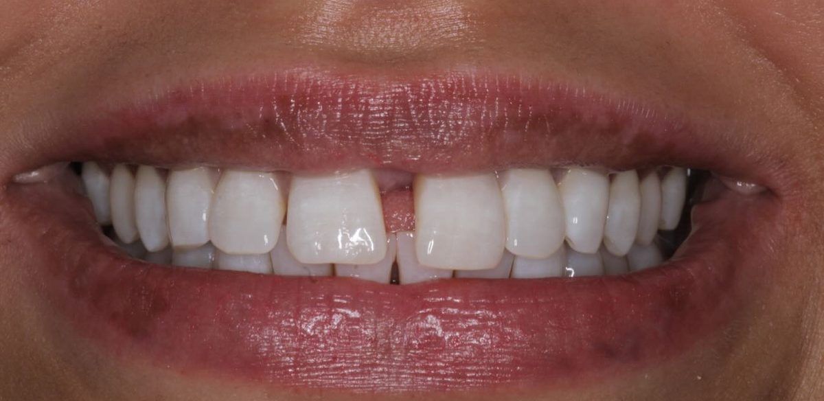 Smile before aligners, whitening and bonding