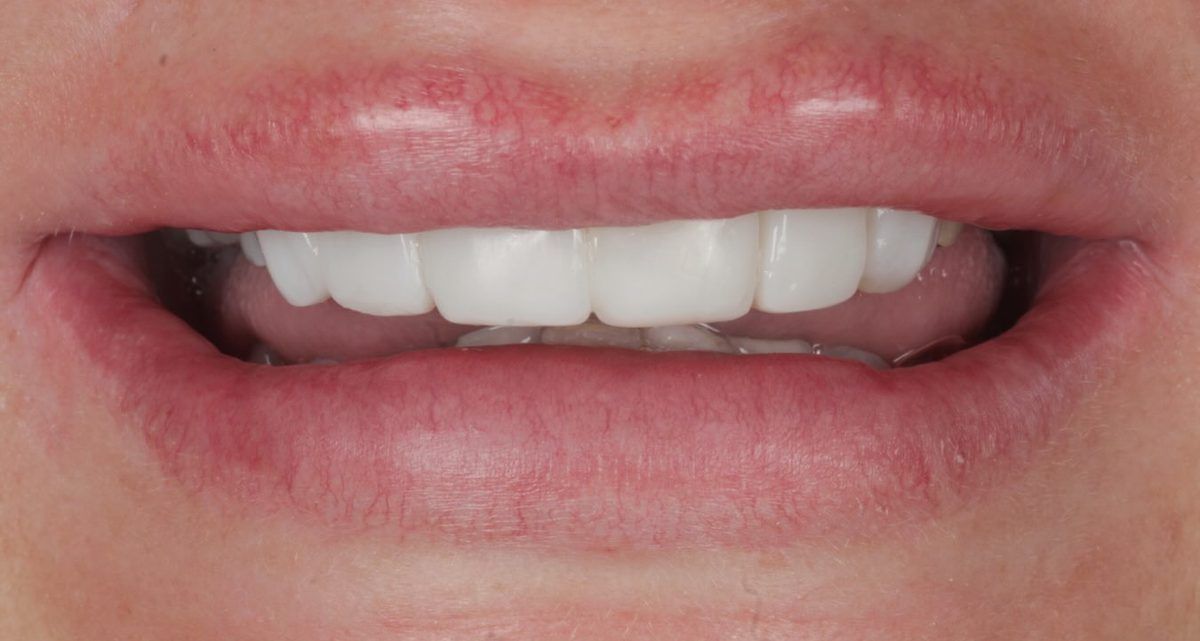 Smile after whitening and bonding for worn teeth