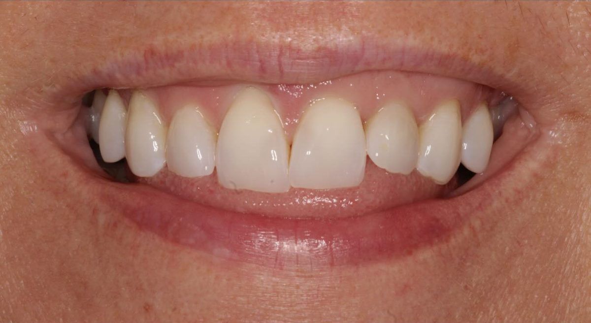 Smile before six porcelain veneers