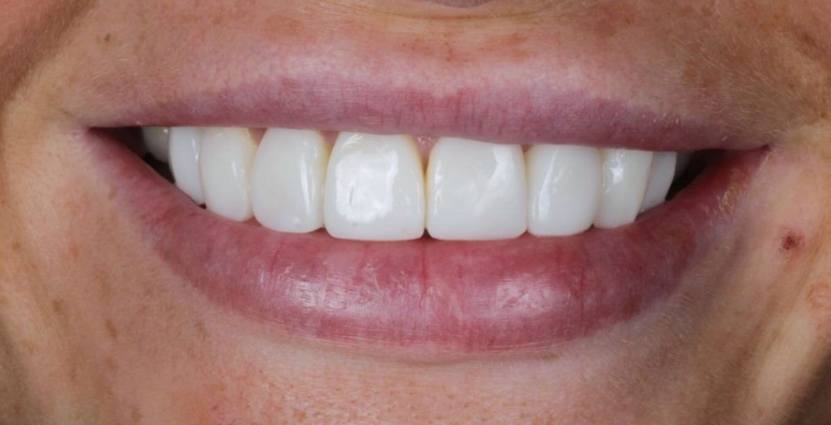 Smile after composite bonding on eight teeth