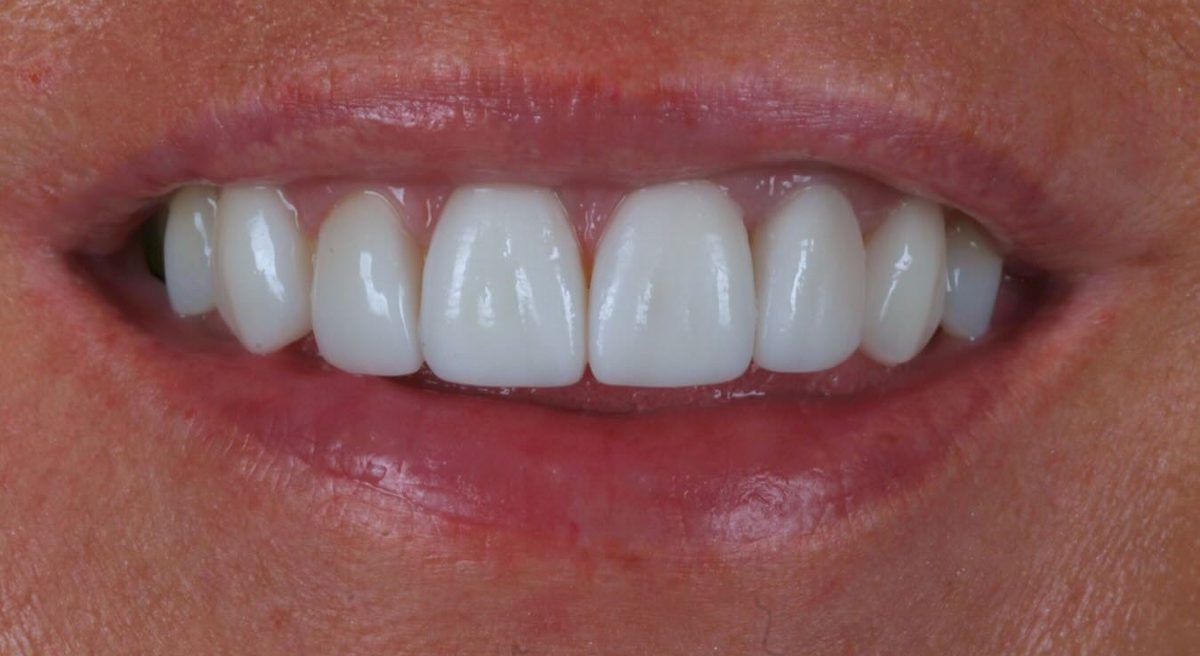 Smile after six porcelain veneers