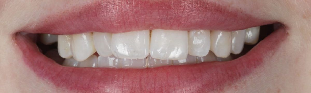 Smile before composite bonding on six teeth