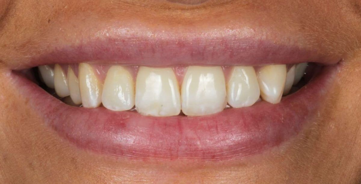 Smile before composite bonding on eight teeth