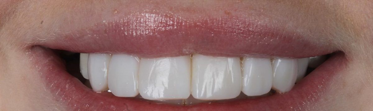 Smile after composite bonding on six teeth