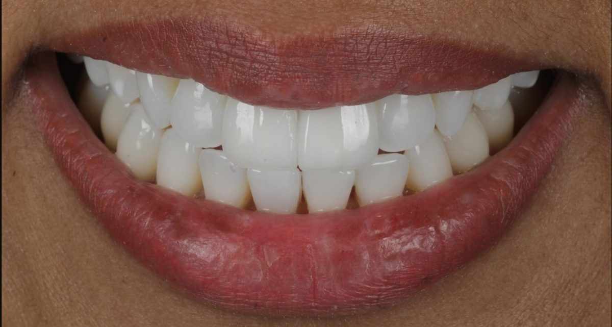 Smile after porcelain veneers for a dark tooth