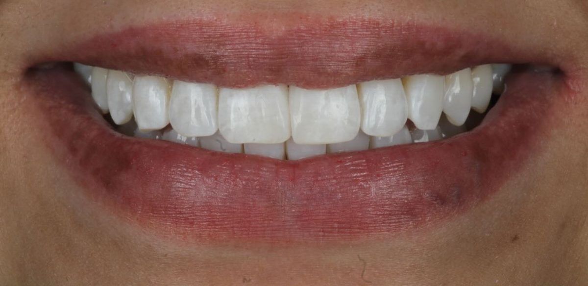 Smile after aligners, whitening and bonding