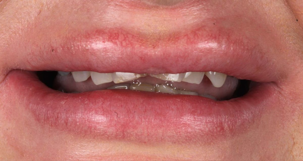 Smile before whitening and bonding for worn teeth