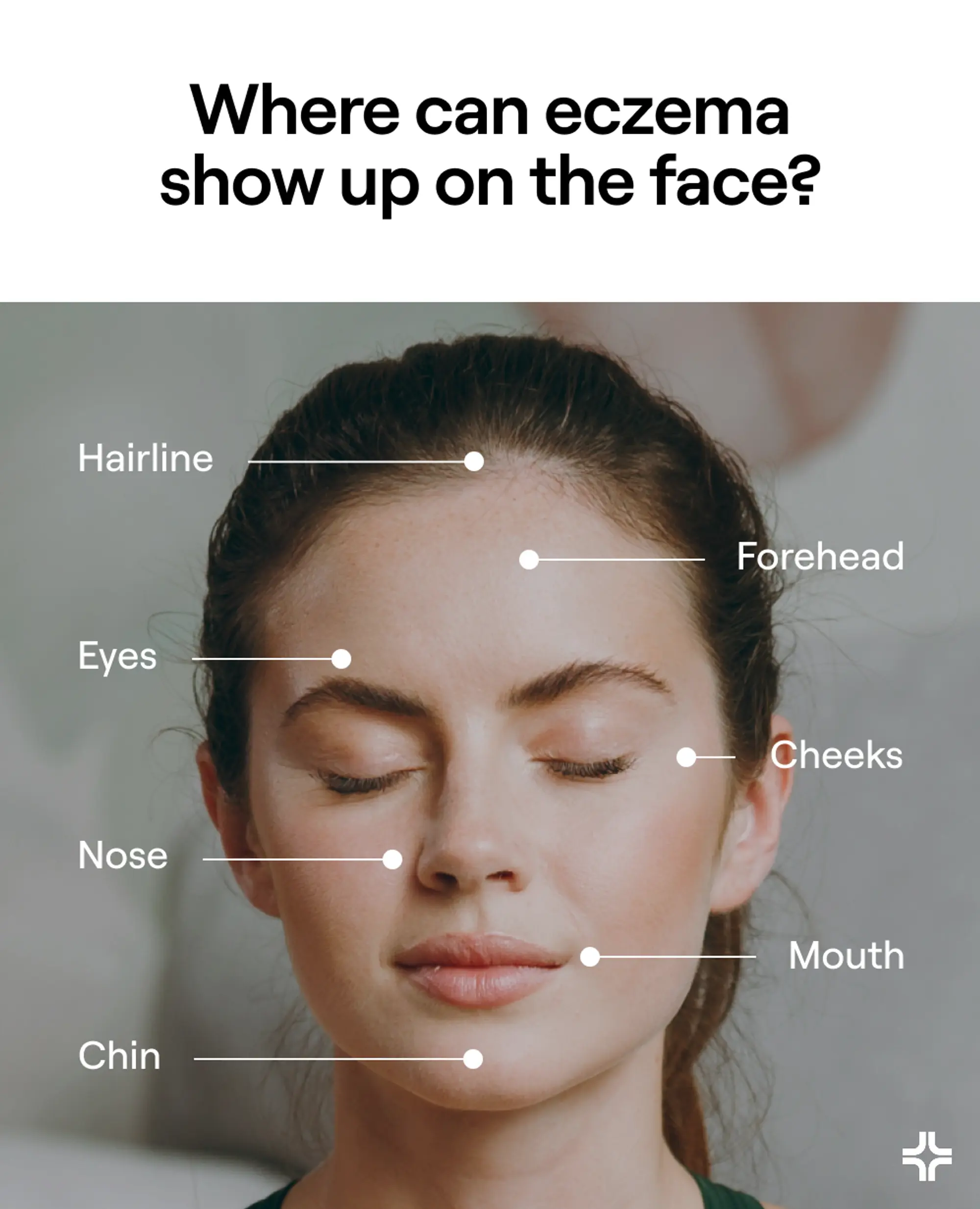 Where eczema can show up on the face