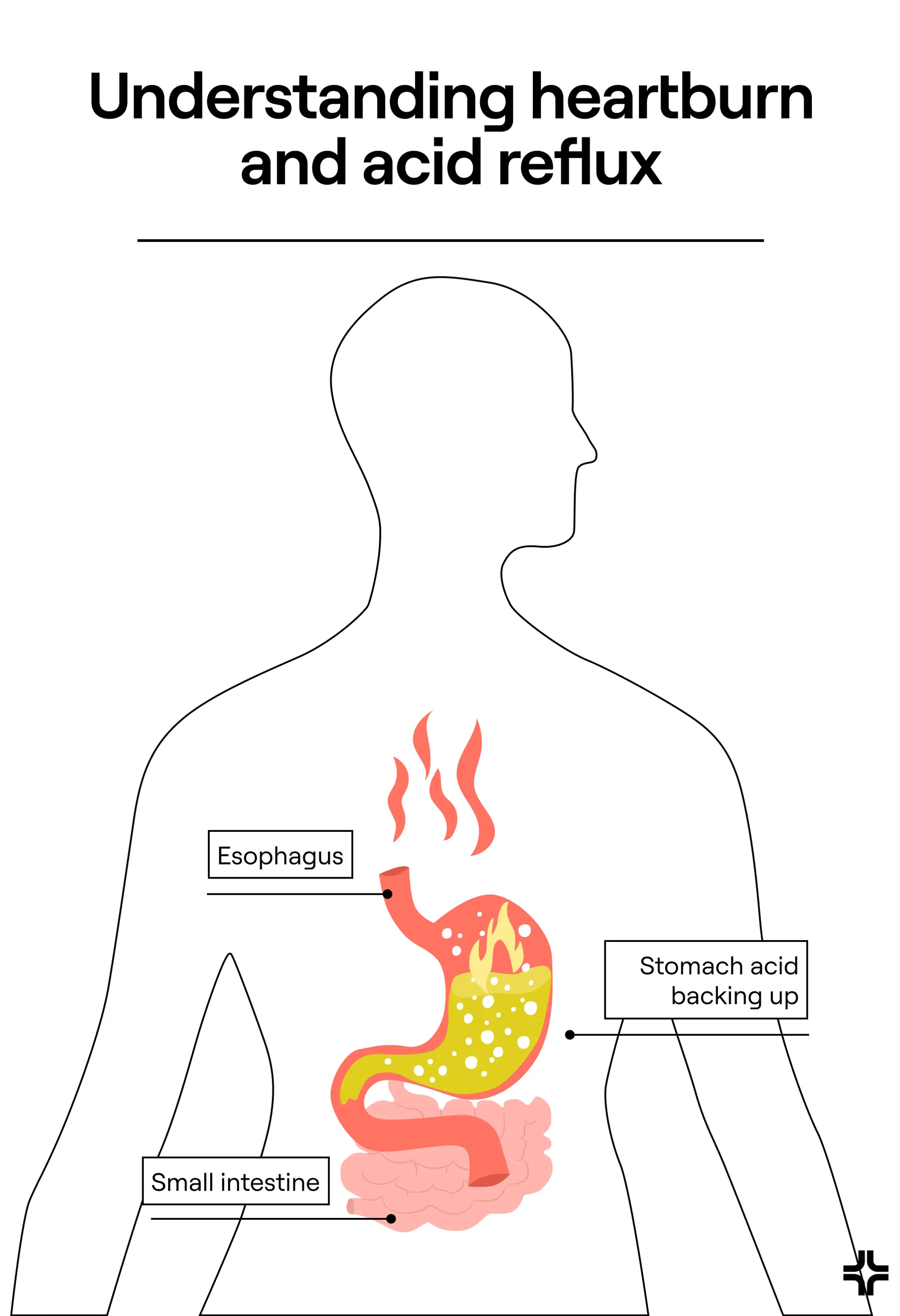 Understanding heartburn and acid reflux
