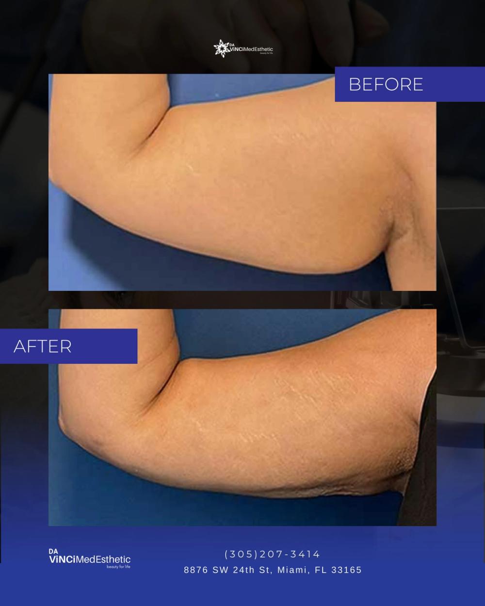 QuantumRF Before and After