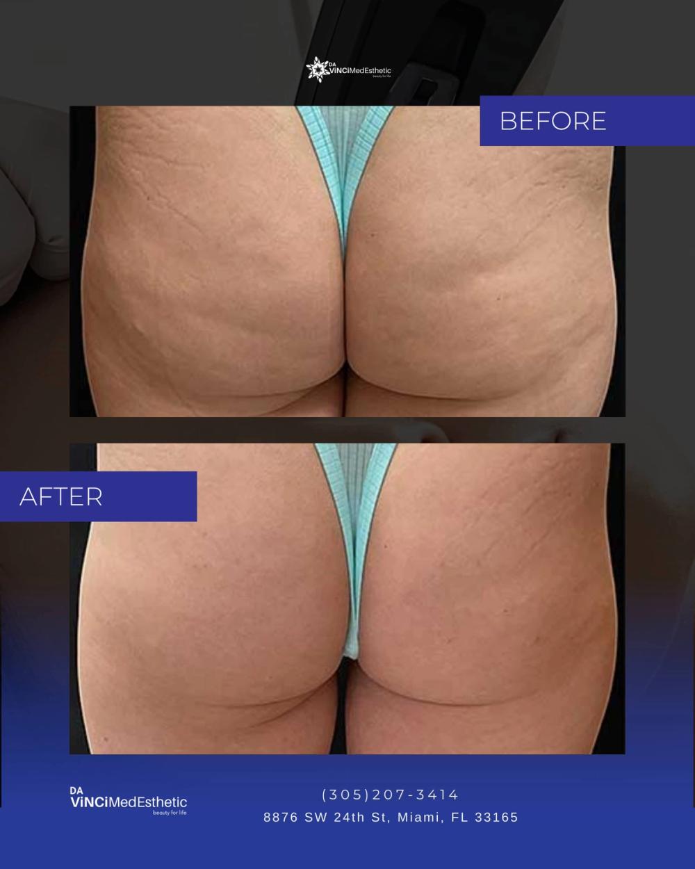 Morpheus8 Before and After