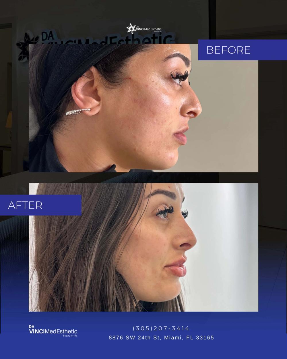 Filler Face Before and After