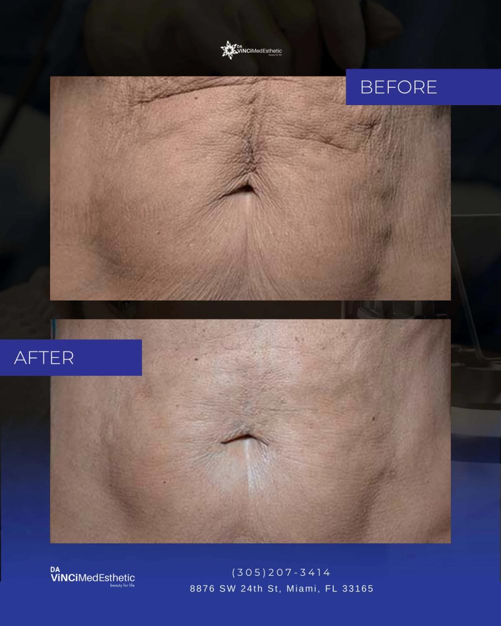QuantumRF Before and After