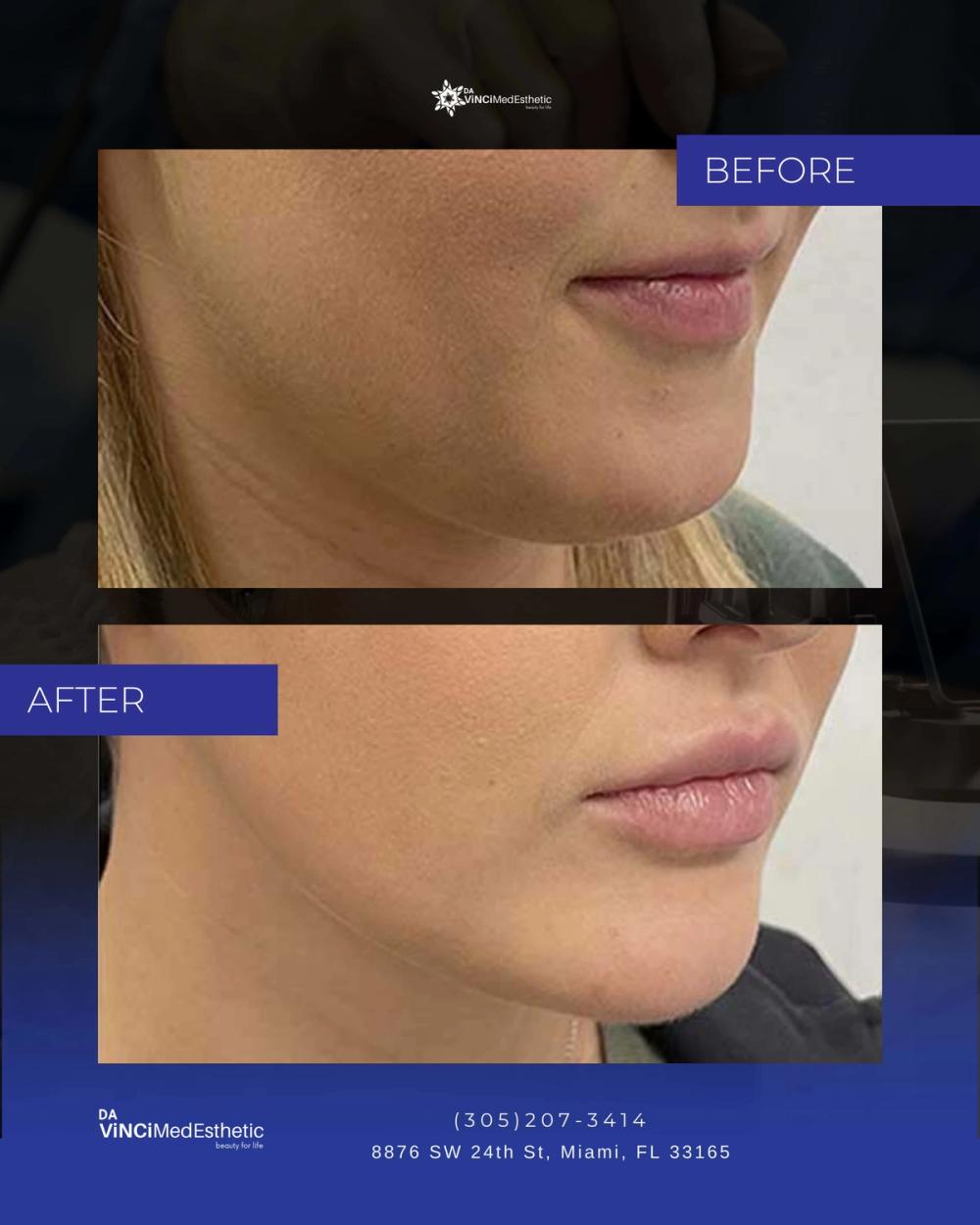 QuantumRF Before and After