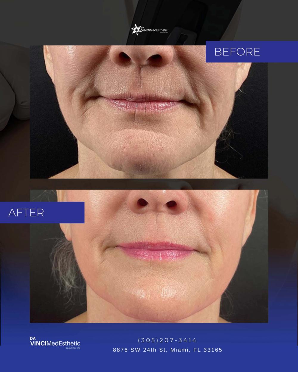 Morpheus8 Before and After