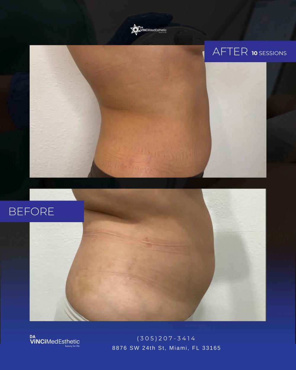 Venus Legacy Before and After